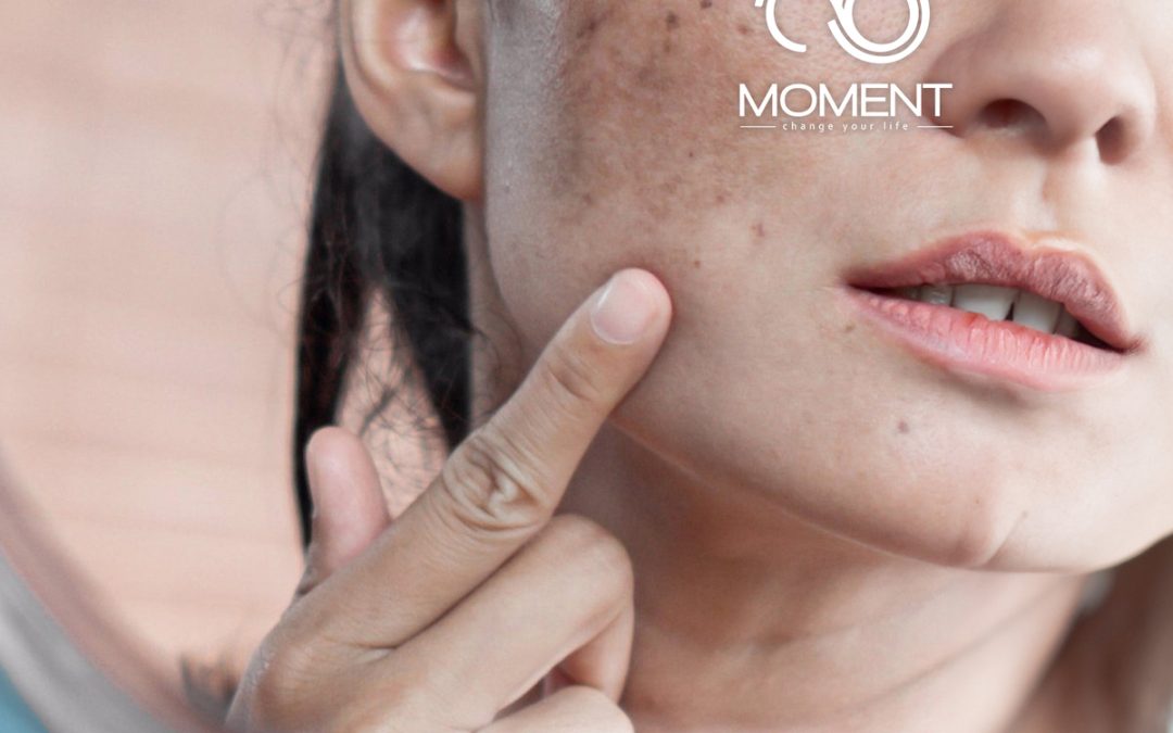 Hiperpigmentasi : Masalah Terbesar Pada Kulit