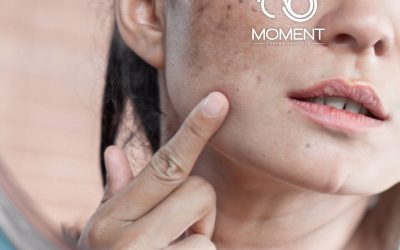 Hiperpigmentasi : Masalah Terbesar Pada Kulit